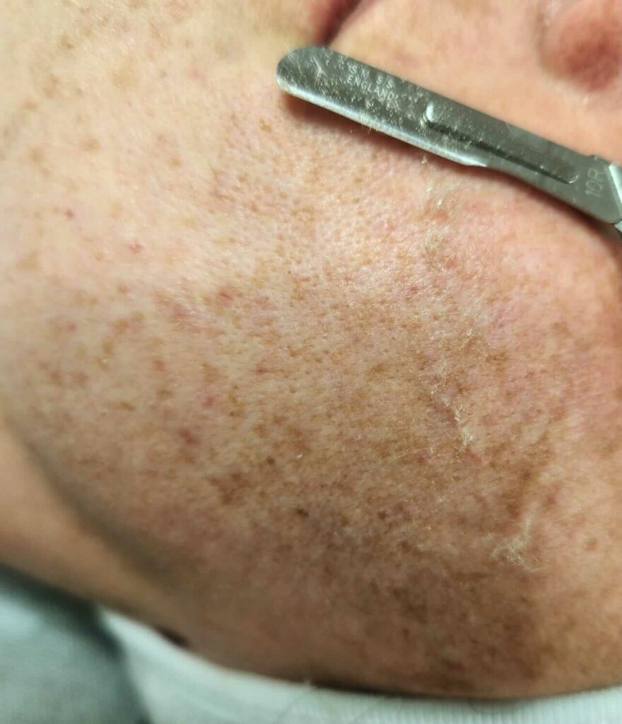 Dermaplaning-Gesichtsbehandlung_Anwendung-1