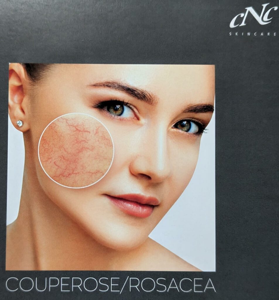 coldplasma_couperose-rosacea